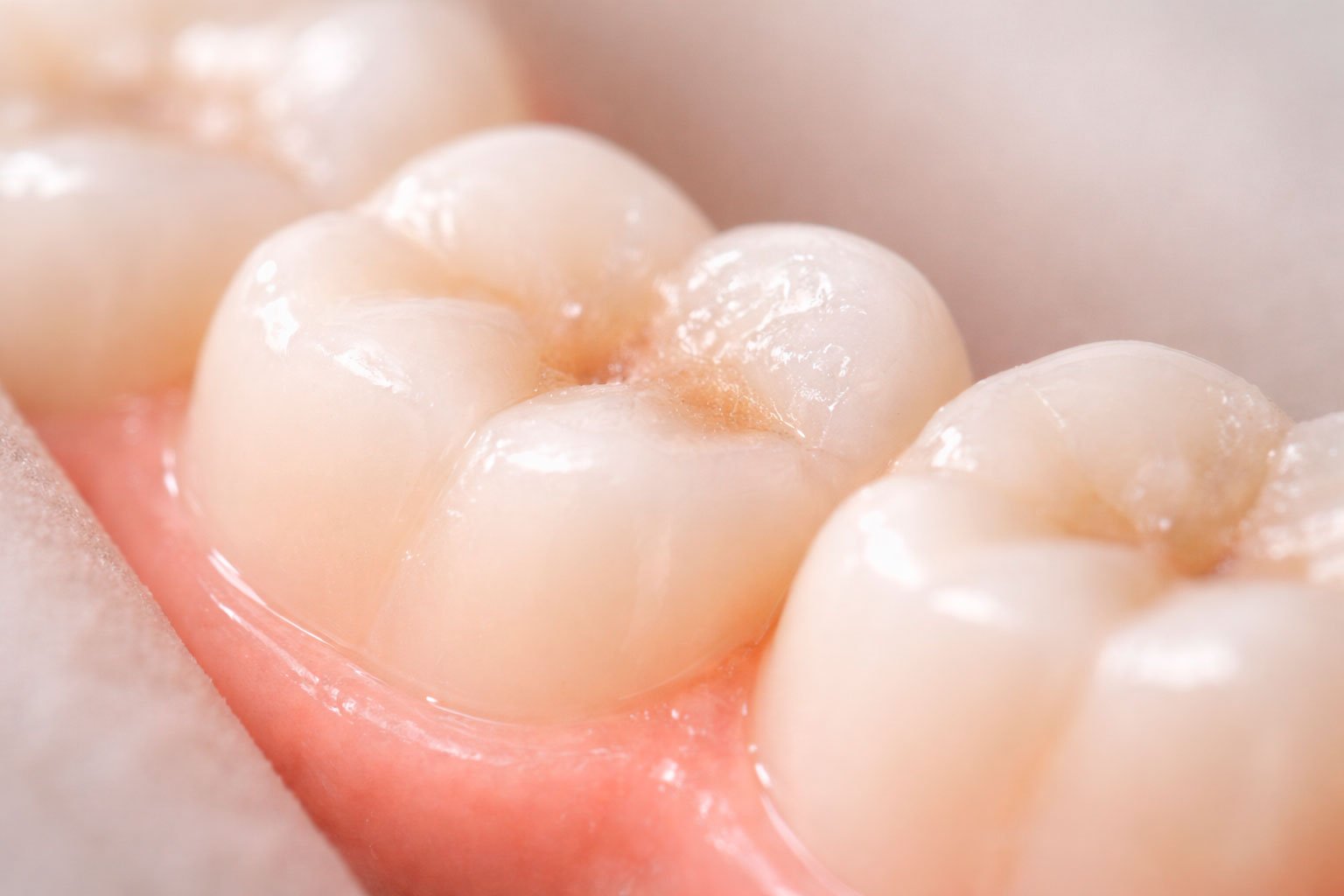Caries dental en estado incipiente