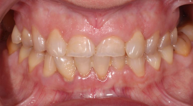 Carillas-Caso-Clinico-200-antes