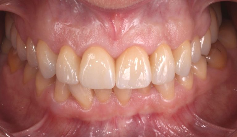 Carillas-Caso-Clinico-200-despues