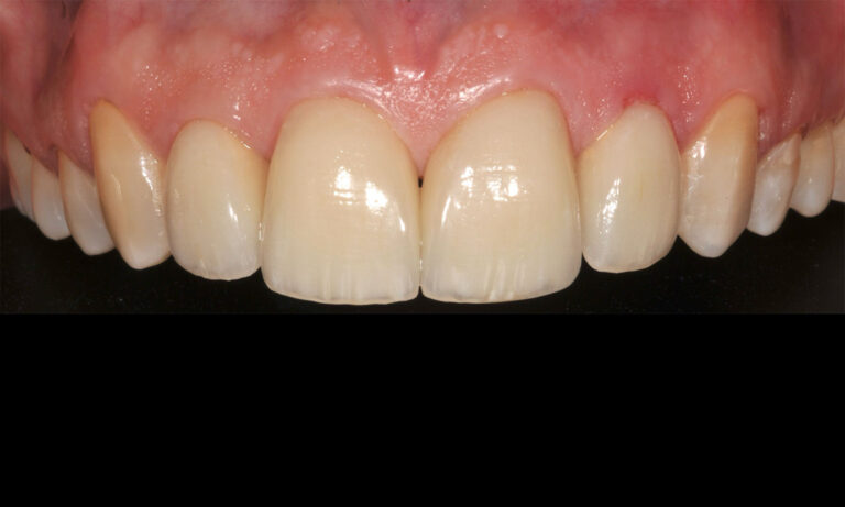 Carillas-Caso-Clinico-31