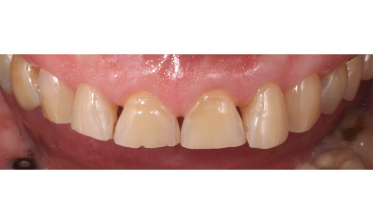 Carillas-Caso-Clinico-32