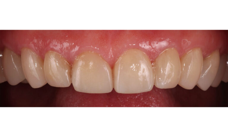 Carillas-Caso-Clinico-33