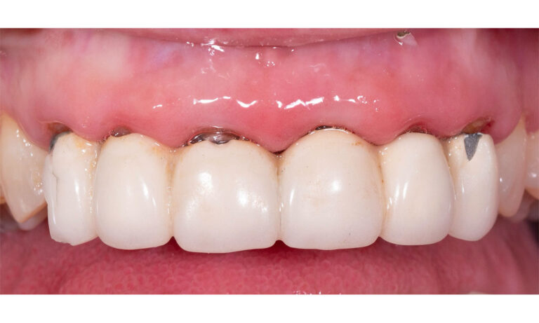 Carillas-Caso-Clinico-34