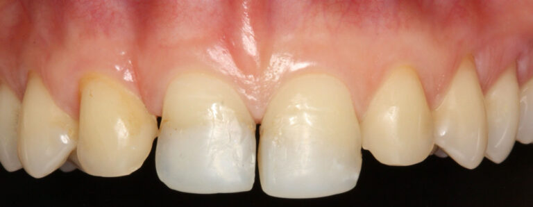 Carillas-Caso-Clinico-50-antes