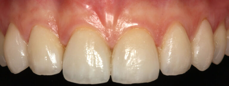 Carillas-Caso-Clinico-50-despues