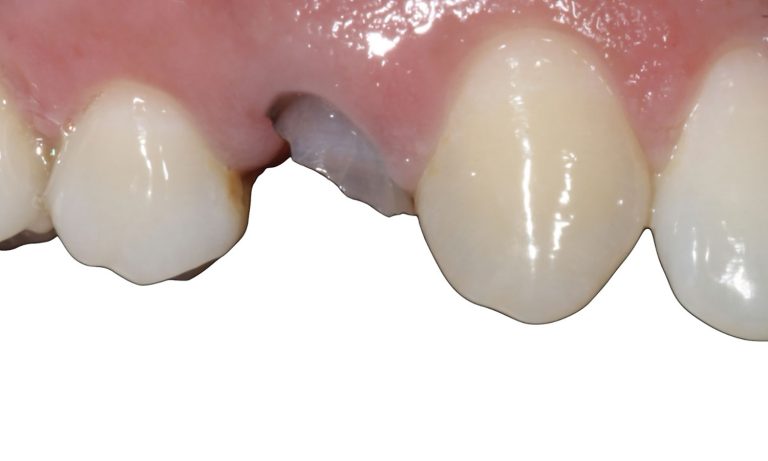 Implante-Caso-Clinico-1