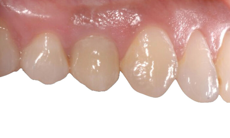 Implante-Caso-Clinico-2