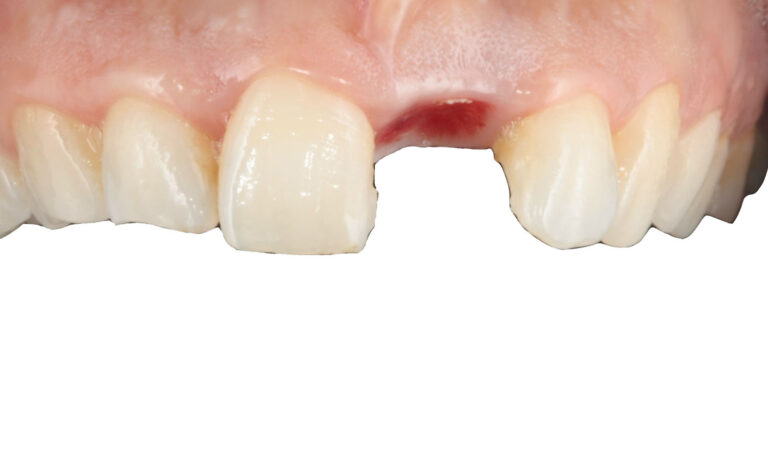 Implante-Caso-Clinico-3