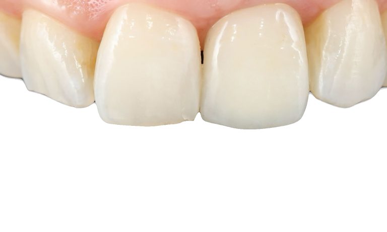 Implante-Caso-Clinico-4