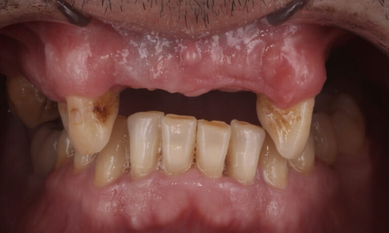 Implante-Caso-Clinico-5