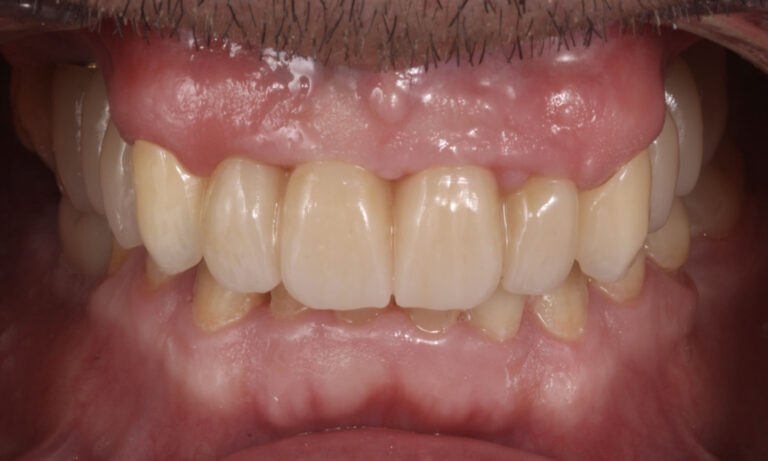 Implante-Caso-Clinico-6