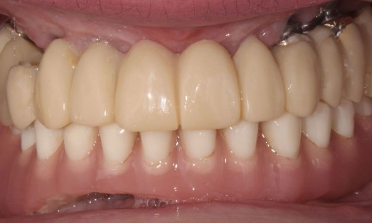 Implantes-Multiples-Caso-Clinico-7