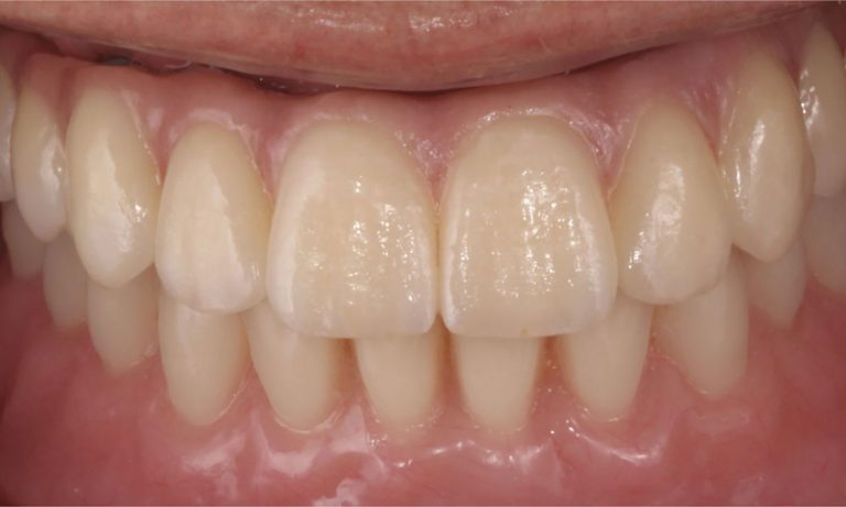 Implantes-Multiples-Caso-Clinico-8