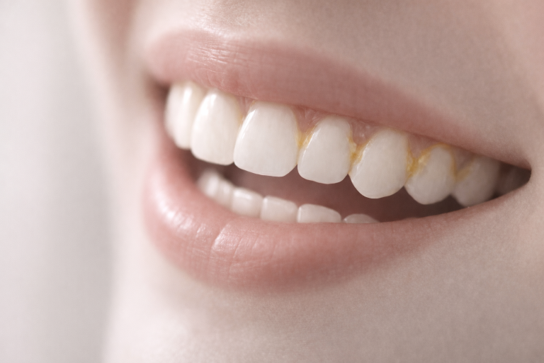 Boca de mujer con placa bacteriana dental presente