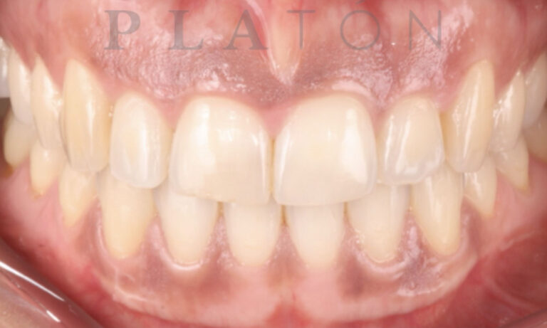 Periodoncia-Caso-Clinico-14