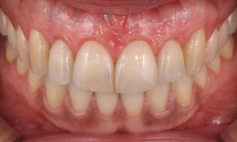 Periodoncia-Caso-Clinico-15