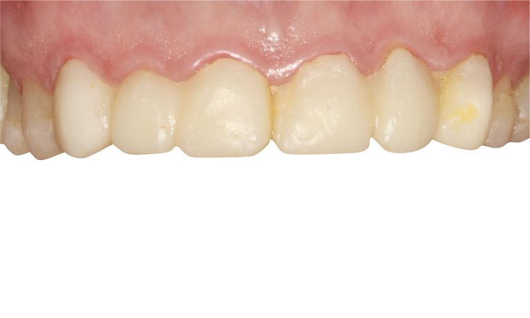 Periodoncia-Caso-Clinico-18