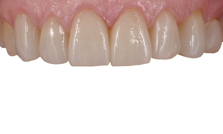 Periodoncia-Caso-Clinico-19