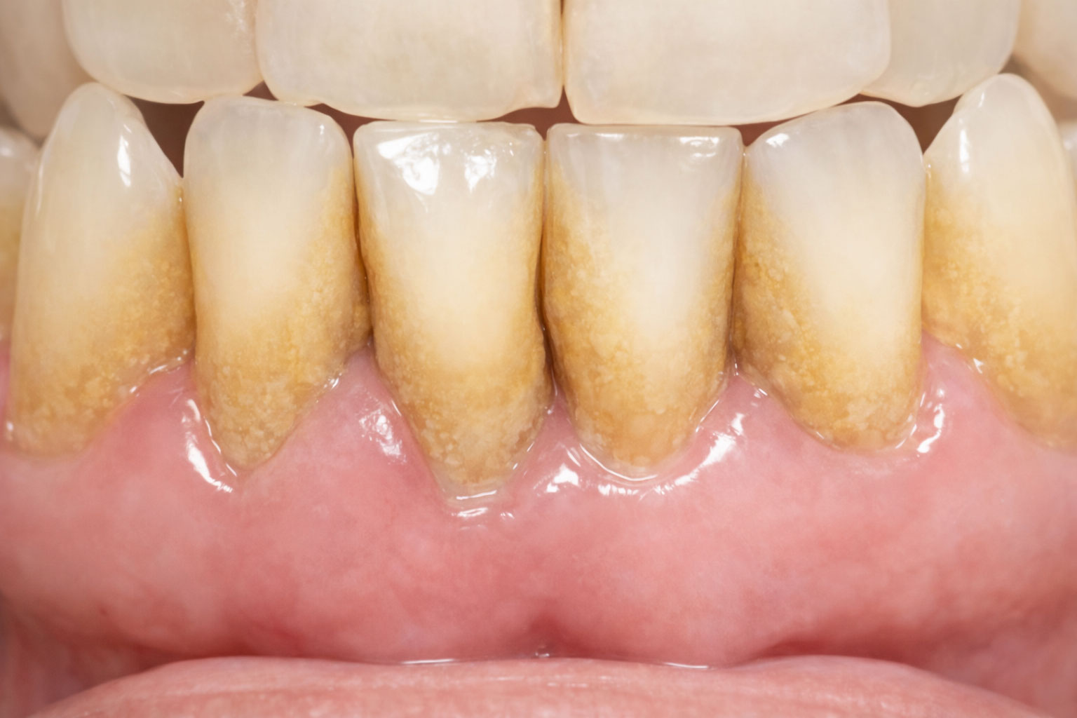 Sarro dental: la silenciosa amenaza de tu boca Sarro dental en pacientes