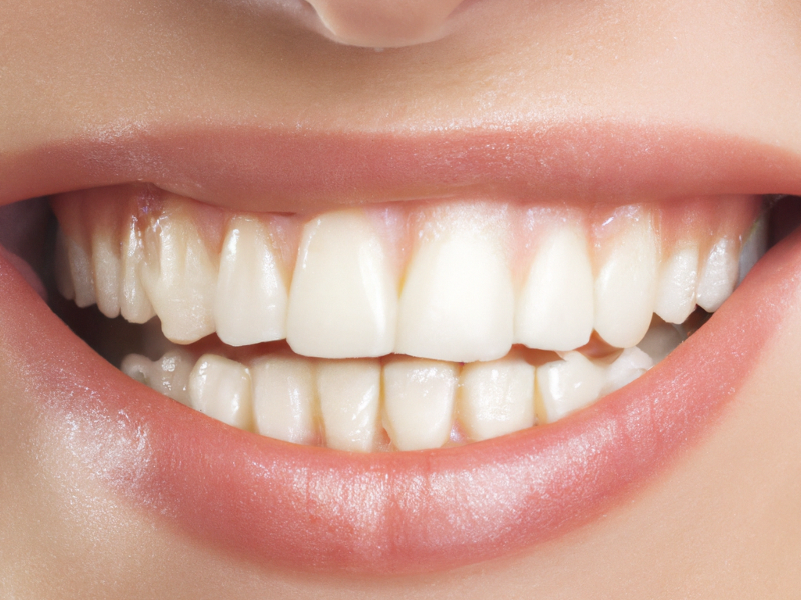 Ortodoncia invisible: tipos, precios, proceso y resultados reales Comparación de alineación dental: antes y después del tratamiento de ortodoncia.